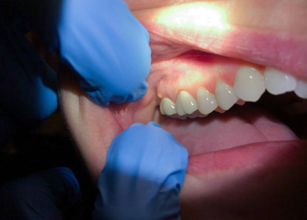 Best Root Canal Emergency Dentist  in Manchester, WA